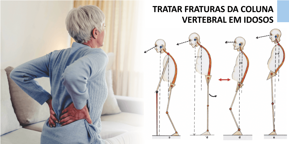 TRATAR FRATURAS DA COLUNA VERTEBRAL EM IDOSOS