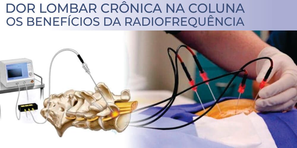 DOR LOMBAR CRÔNICA NA COLUNA | <strong>OS BENEFÍCIOS DA RADIOFREQUÊNCIA</strong>