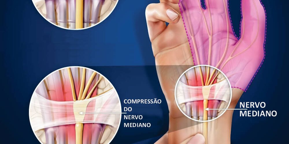 SÍNDROME DO TUNEL DO CARPO QUAL O MELHOR TRATAMENTO PARA O SEU CASO?