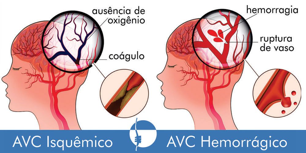 Qual a diferença entre AVC Isquêmico e AVC Hemorrágico?