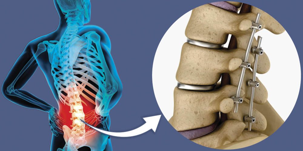 Alívio para a Dor: Entenda a Artrodese Lombar e Seus Benefícios