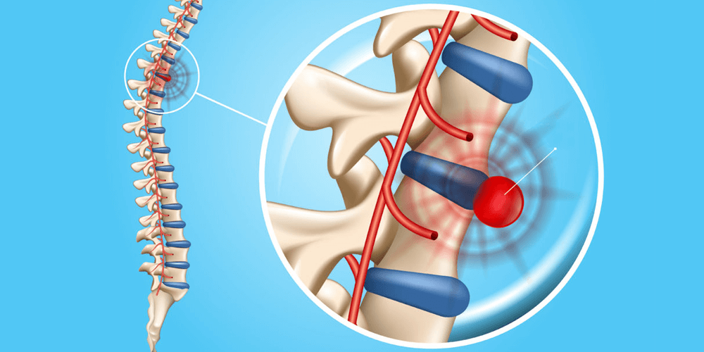 Mesmo após cirurgia, a hérnia de disco pode voltar? - Clínica da