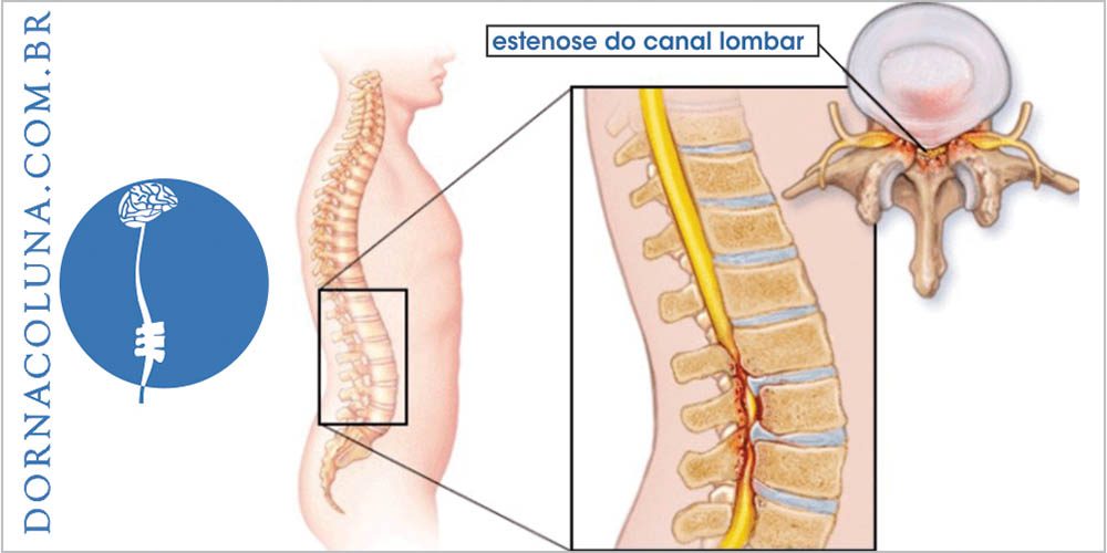 Estenose do canal lombar: possibilidades de tratamentos.