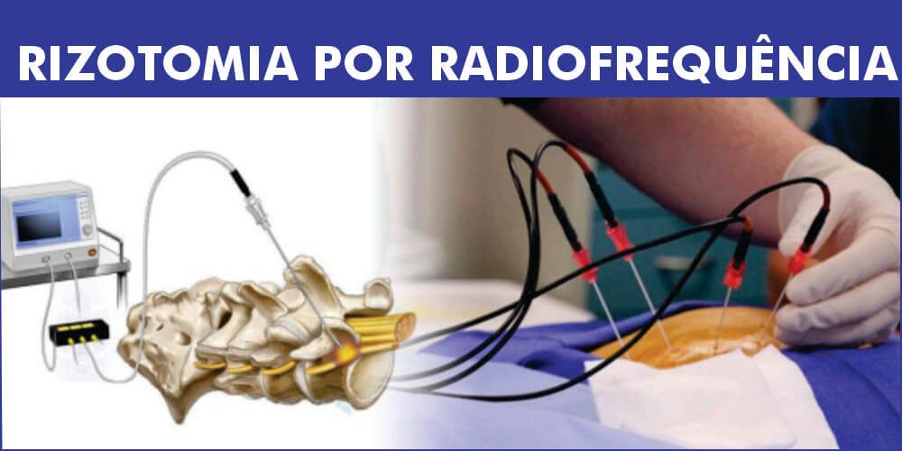 Rizotomia por radiofrequência tratamento minimamente invasivo para doenças da coluna